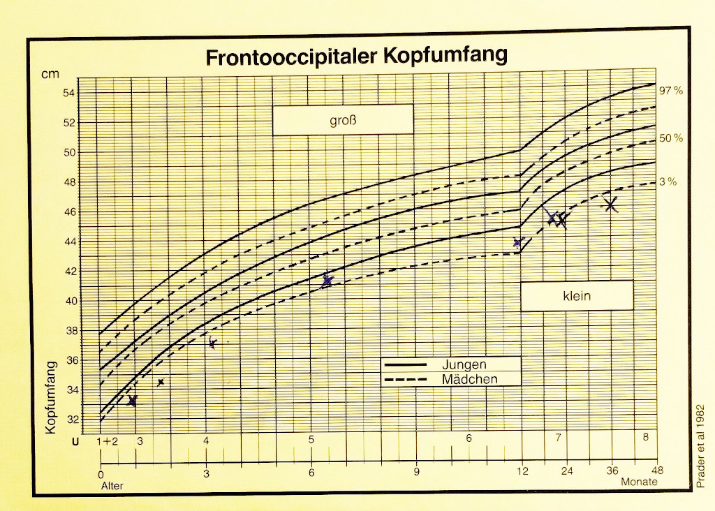 Fetales Alkoholsyndrom der Lidspalte